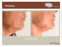 microneedling-2