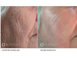 microneedling-5