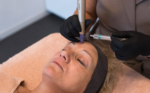 Microneedling