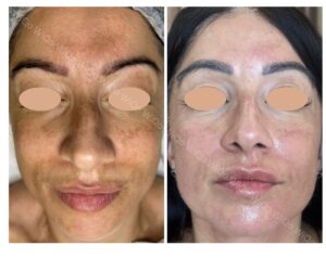 PRX-PLUS behandeling tegen pigment bij LE MASQUE schoonheidssalon in Cuijk