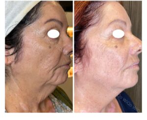 PRX-PLUS behandeling tegen rimpels en verslapping bij LE MASQUE huidinstituut in Cuijk